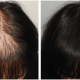Acell therapy for hair loss
