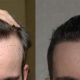 fue-hairline-before-after