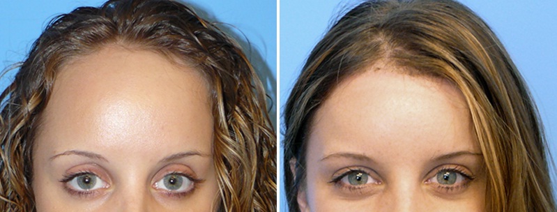 hairline restoration procedure