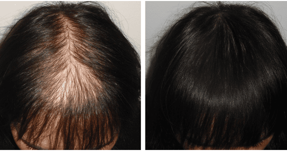 Acell therapy for hair loss