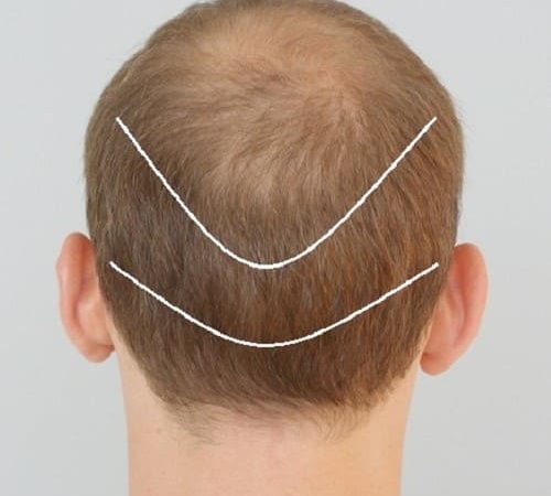 Donor Areas for Hair Transplant