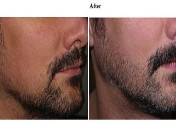 Facial Hair Transplant in Saudi Arabia