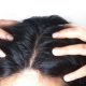 Hair loss treatment in Saudi Arabia