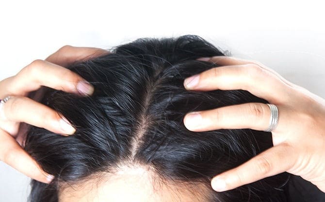 Hair loss treatment in Saudi Arabia
