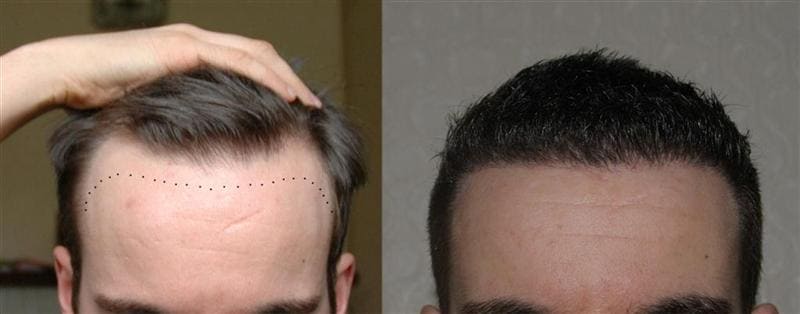fue-hairline-before-after