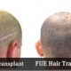 fue-vs-fut-hair-transplant-260x139