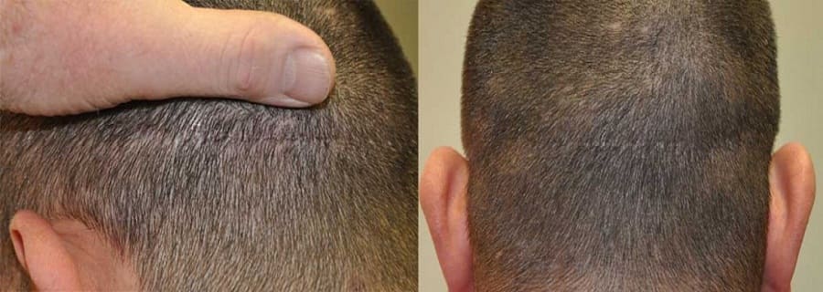 fut-treatment-before-after