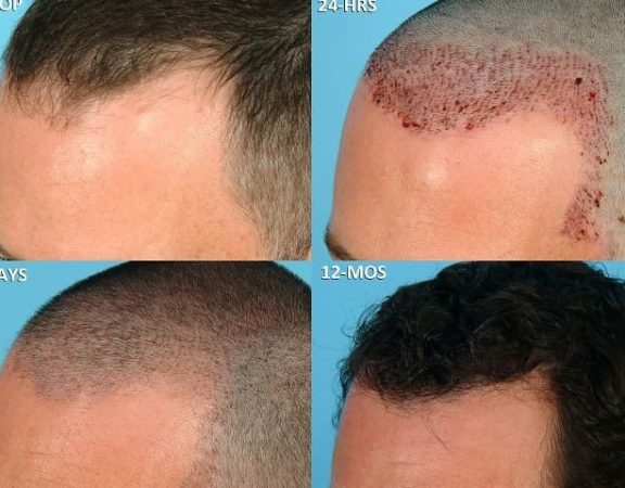 hair-transplant-scabs