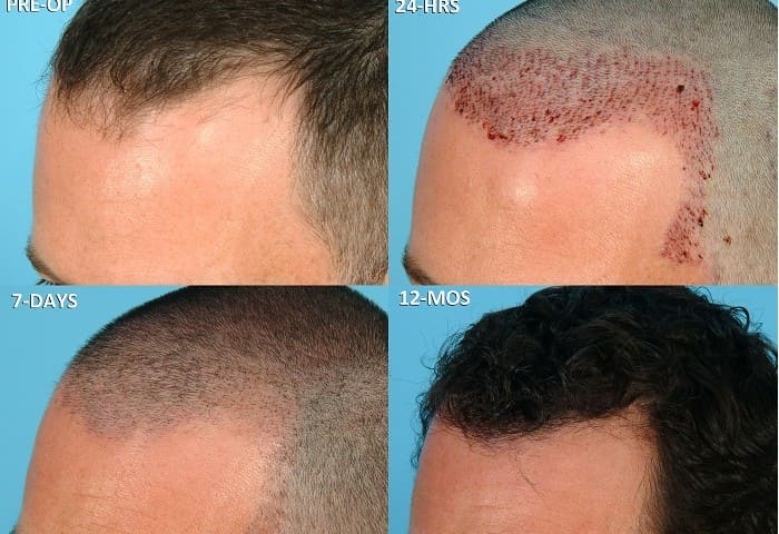 hair-transplant-scabs