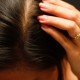 itchy Scalp Hair Loss