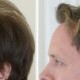 before after hair transplant surgery