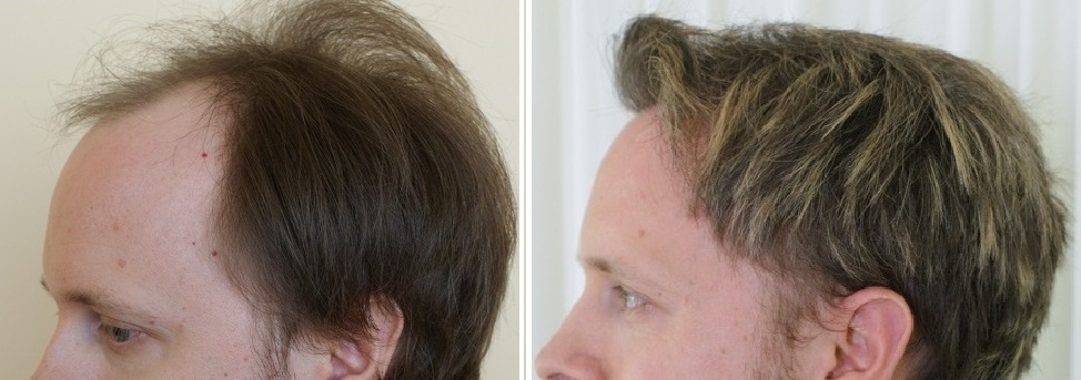 before after hair transplant surgery