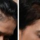 stem-cell-therapy-for-hair-loss-