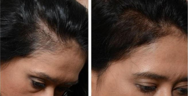 stem-cell-therapy-for-hair-loss-