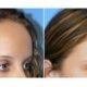 scar-free-hairline-restoration