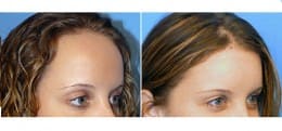 scar-free-hairline-restoration