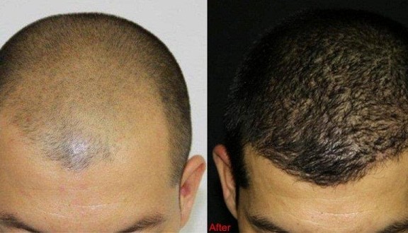 before and after Stemcell fue hair transplant