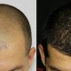 before and after Stemcell fue hair transplant