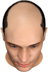 Complete Balding of the Upper Head