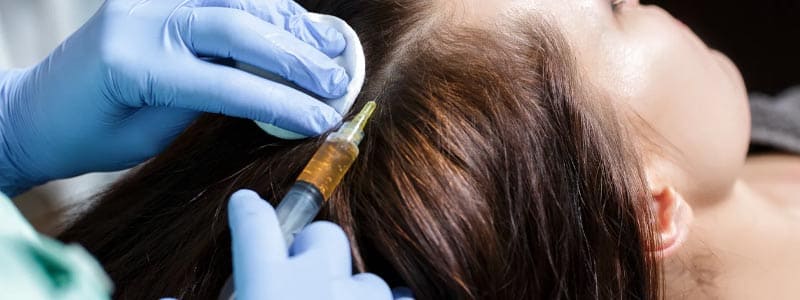 ACellPRP Hair Loss Therapy