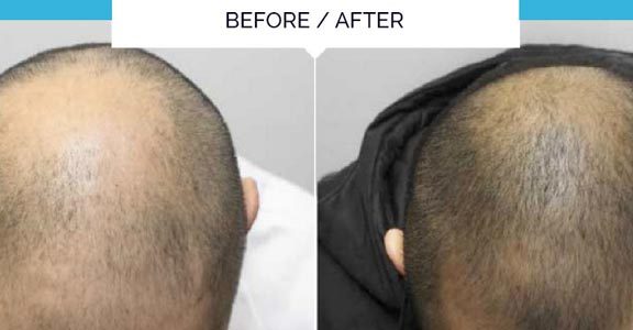 Hair loss treatment in Saudia