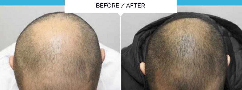 Hair loss treatment in Saudia